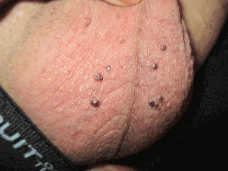 Penile Yeast Infection - Diseases Pictures