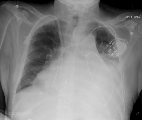 Massive Pericardial Effusion Causing hemithorax Whiteout Massive Pericardial Effusion Causing hemithorax Whiteout