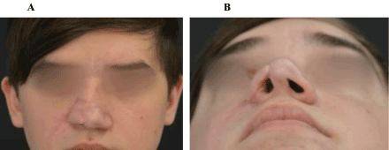 Ablative dog bites involving the childish nose