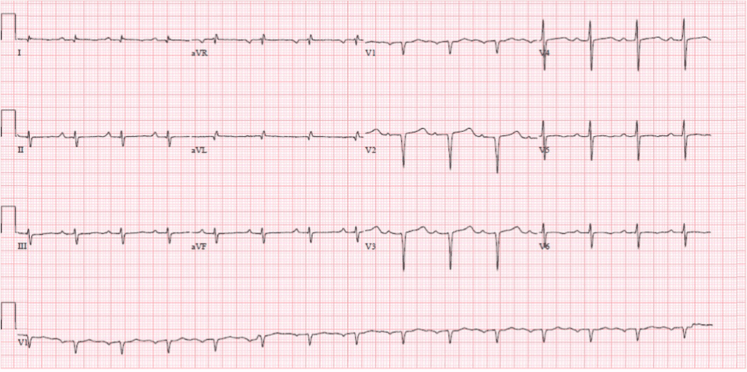 A case of cardiac amyloidosis with left ventricular outflow obstruction  with significant response to therapy