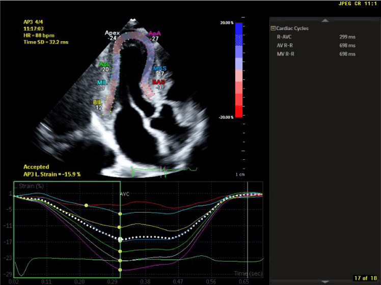 2D/3D strain analysis in a patient with cardiac amyloidosis. Upper
