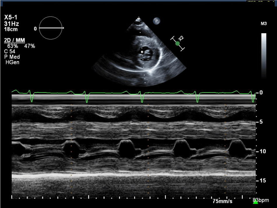 Apical sparing of longitudinal strain in speckle-tracking echocardiography