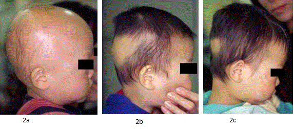 Herb lotions to regrow hair in patients with intractable alopecia areata