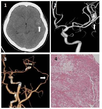 Distal Middle Cerebral Artery Fusiform Aneurysm Associated with ...