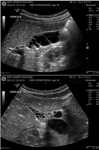 gallstones ultrasound removal