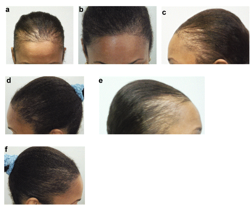 African American hair loss – what can be done?
