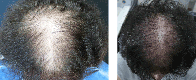 Clinical evaluation of a novel fractional radiofrequency based device for hair  growth stimulation