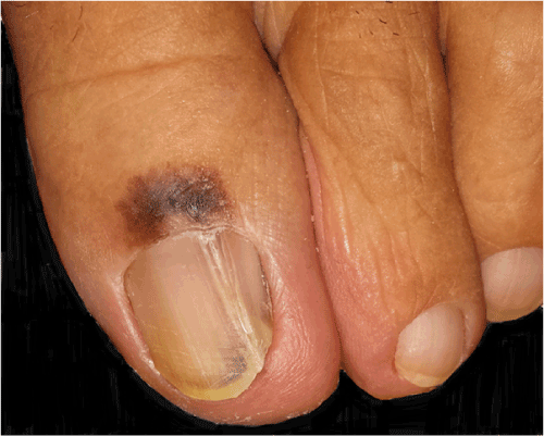 Subungual melanoma in association with subungual epidermoid inclusions