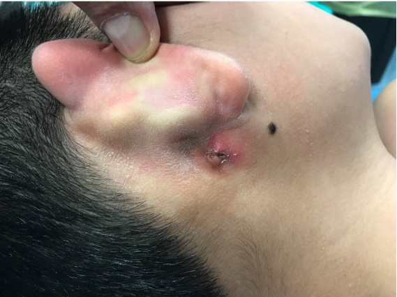 first branchial cleft cyst