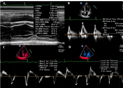 Prevalence of left ventricular geometric patterns in hypertensive patients in Angola