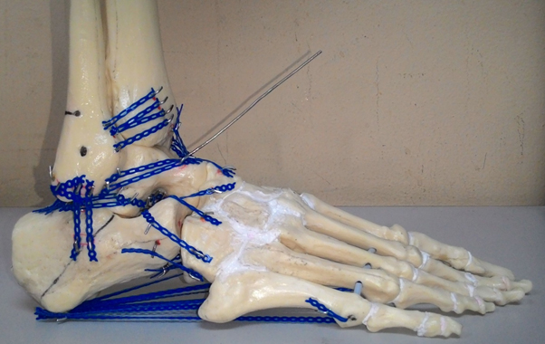 gorgeous Unpacking educator The use of external fixator for ankle and foot injuries management-a review  on biomechanical perspective