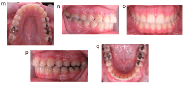 Ankylosed Permanent Teeth Incidence Etiology And Guidelines For Clinical Management