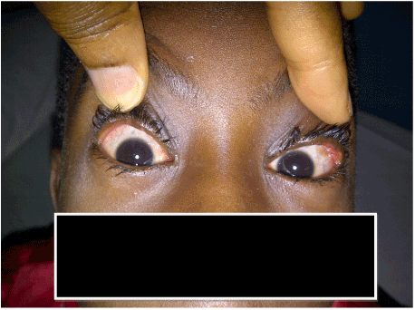 conjunctival squamous papilloma)