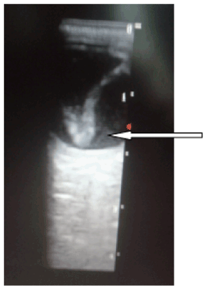 B-scan opthalmic Ultrasonography: a review corroborated with echograms