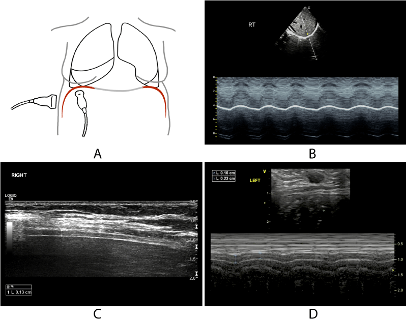 Clinical application of ultrasound in paediatric diaphragmatic