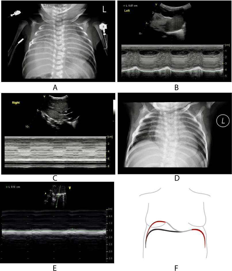 Clinical application of ultrasound in paediatric diaphragmatic