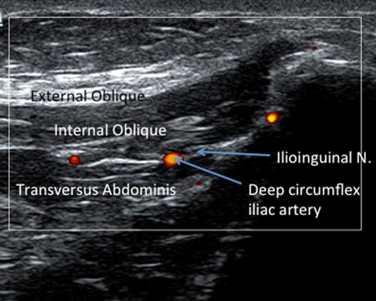 ilioinguinal nerve block ultrasound