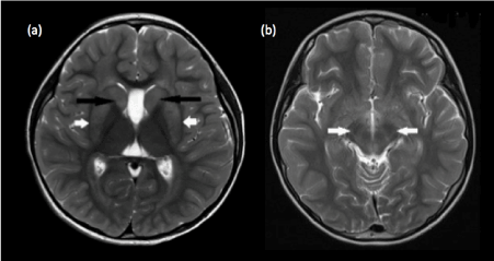 Pediatric MRI Brain: Normal or abnormal, that is the question.
